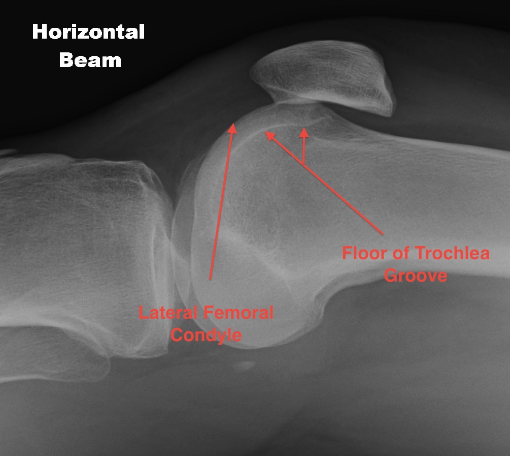 Trochlea Normal Anatomy Diagram